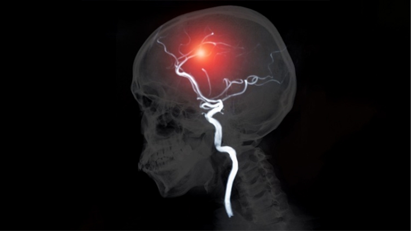 Top 6 Things You Need To Know About Stroke