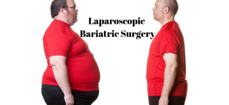 Laparoscopic Bariatric Surgery: Boone For Obesity