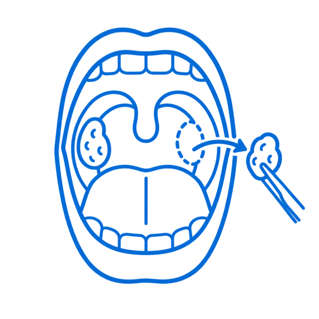 Tonsillectomy Surgery in Bangalore